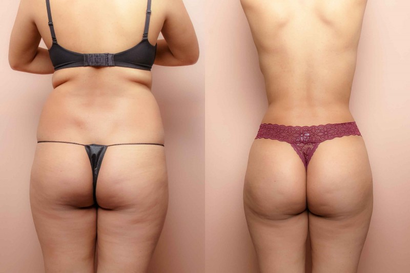 BBL Surgery Deals New York City